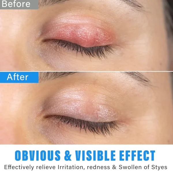 Chalazion Vision Treatment Serum for Fast Relief