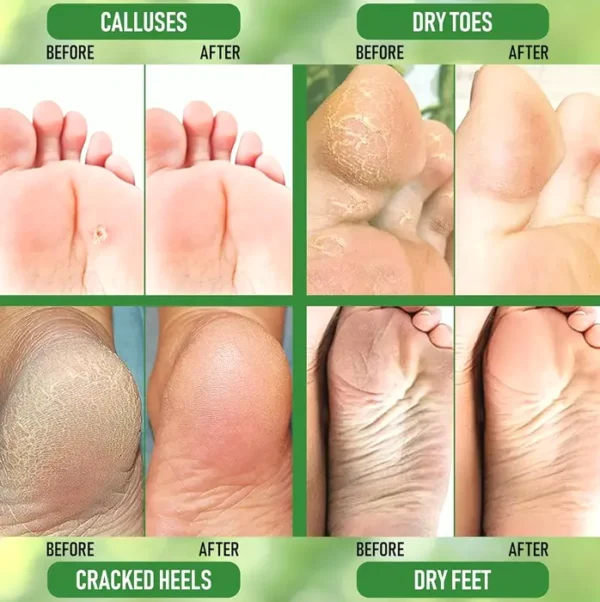 Urea 40% Foot Cream for Dry Feet
