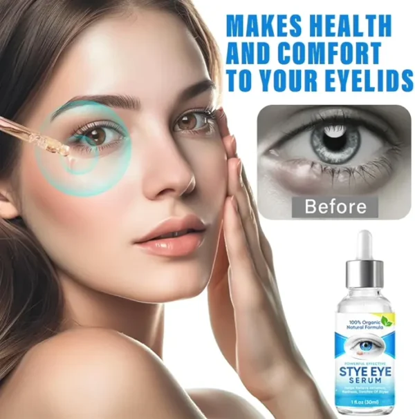 Chalazion Vision Treatment Serum for Fast Relief